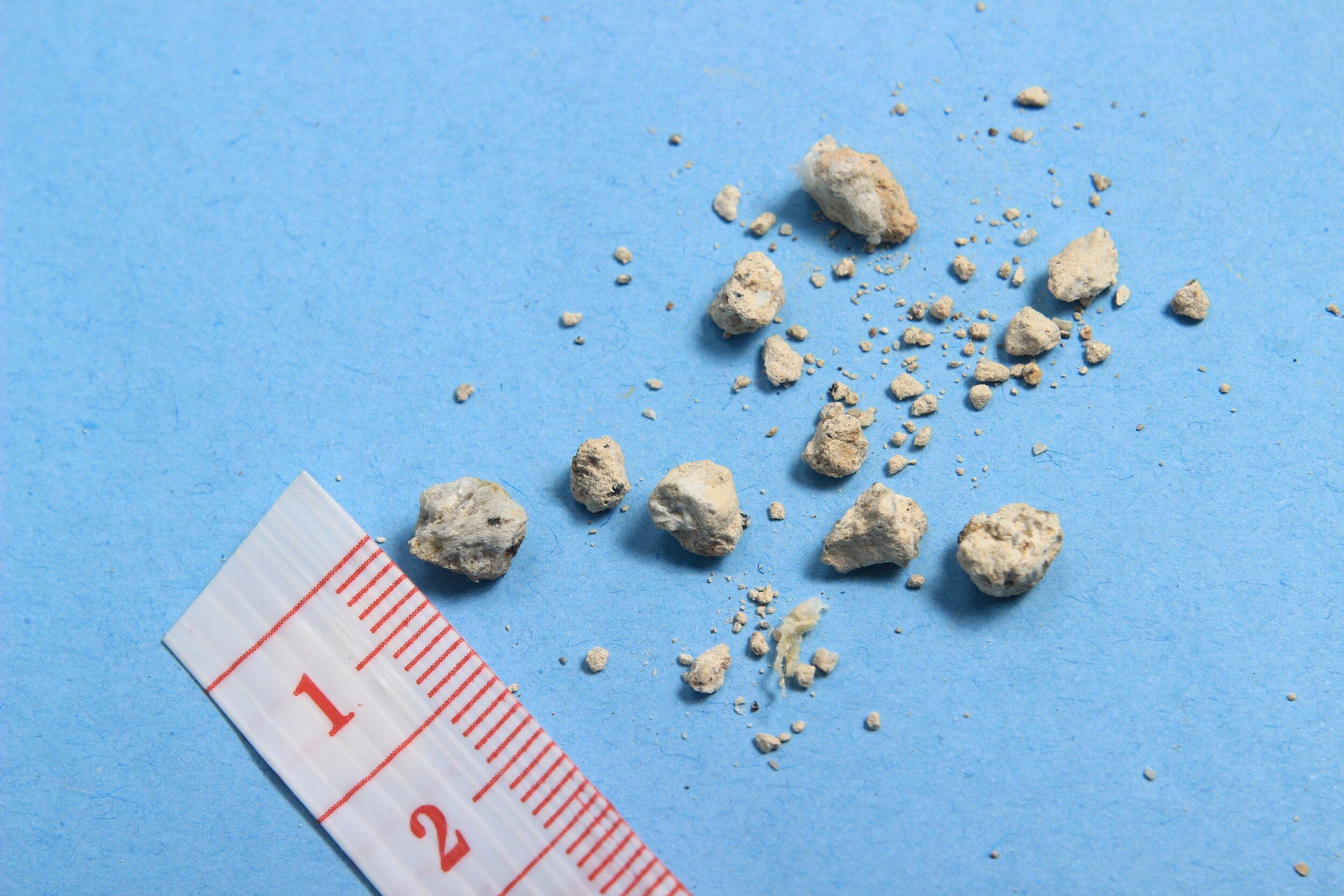 Five Ways to Prevent Kidney Stones